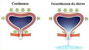 Incontinenza Urinaria